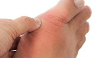 Arthritis in the Big Toe Joint