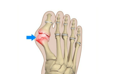 Bunion Deformity – Podiatry Network