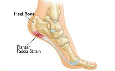 Heel Pain, Heel Spurs – Podiatry Network