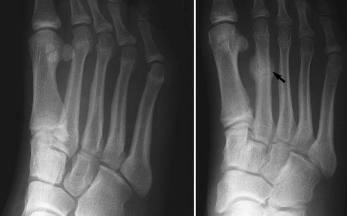 ankle hairline fracture