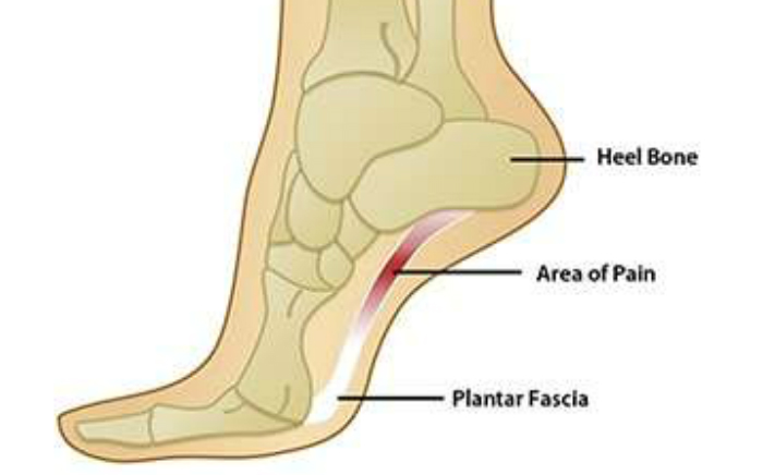 Transforming Foot Arch Pain | Podiatrist in Walnut Creek
